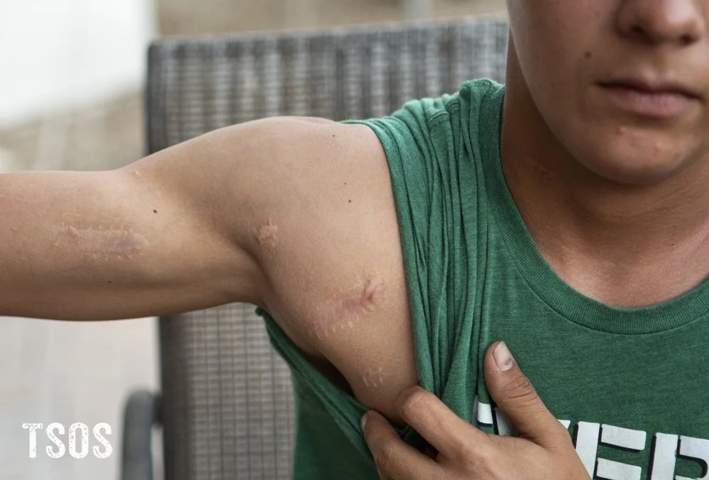  Eduardo shows some of the scars that remain after he was attacked by local gang members with machetes for not agreeing to sell drugs through his family’s fruit stand in Honduras. Photo provided by Their Story is Our Story. 