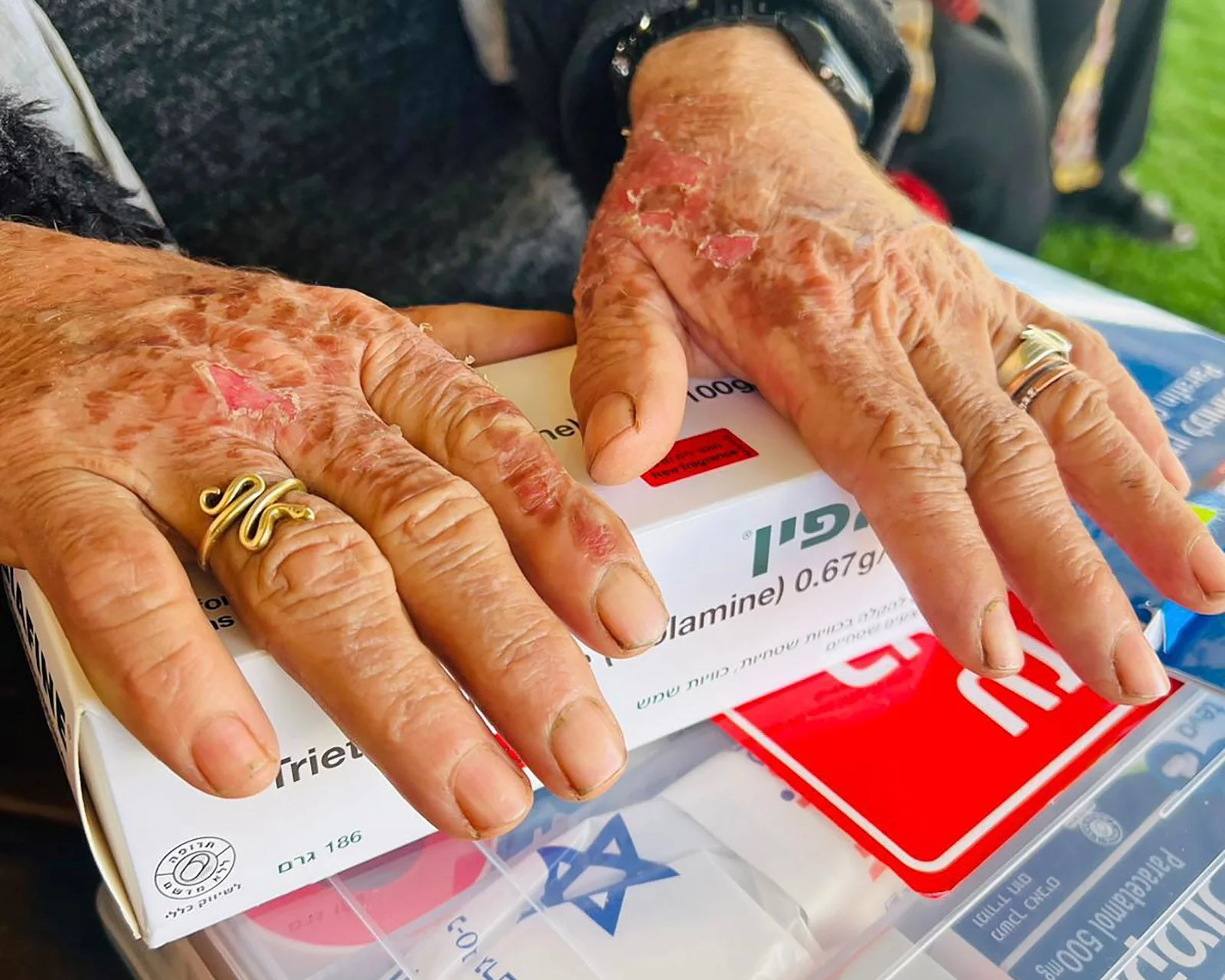  Layla’s hands, burned by a fire that reduced her home to ashes. 