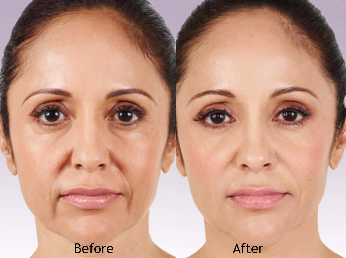 juvederm_beforeafter.jpg