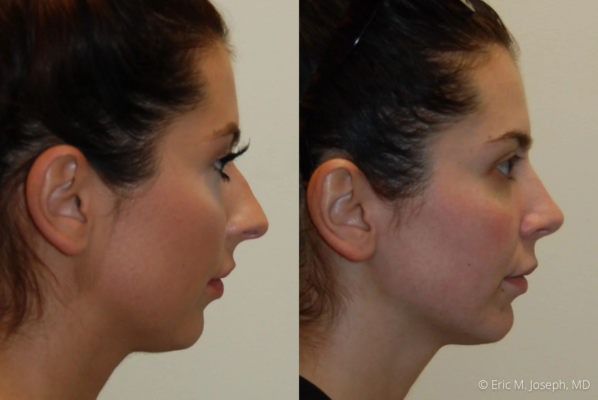 Eric M Joseph Md Rhinoplasty Information Dr Eric M Joseph
