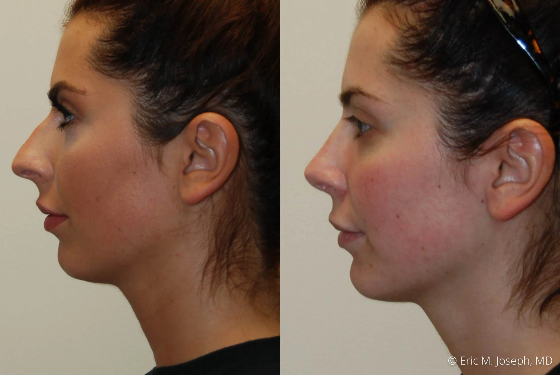 Eric M Joseph Md Rhinoplasty Information Dr Eric M Joseph