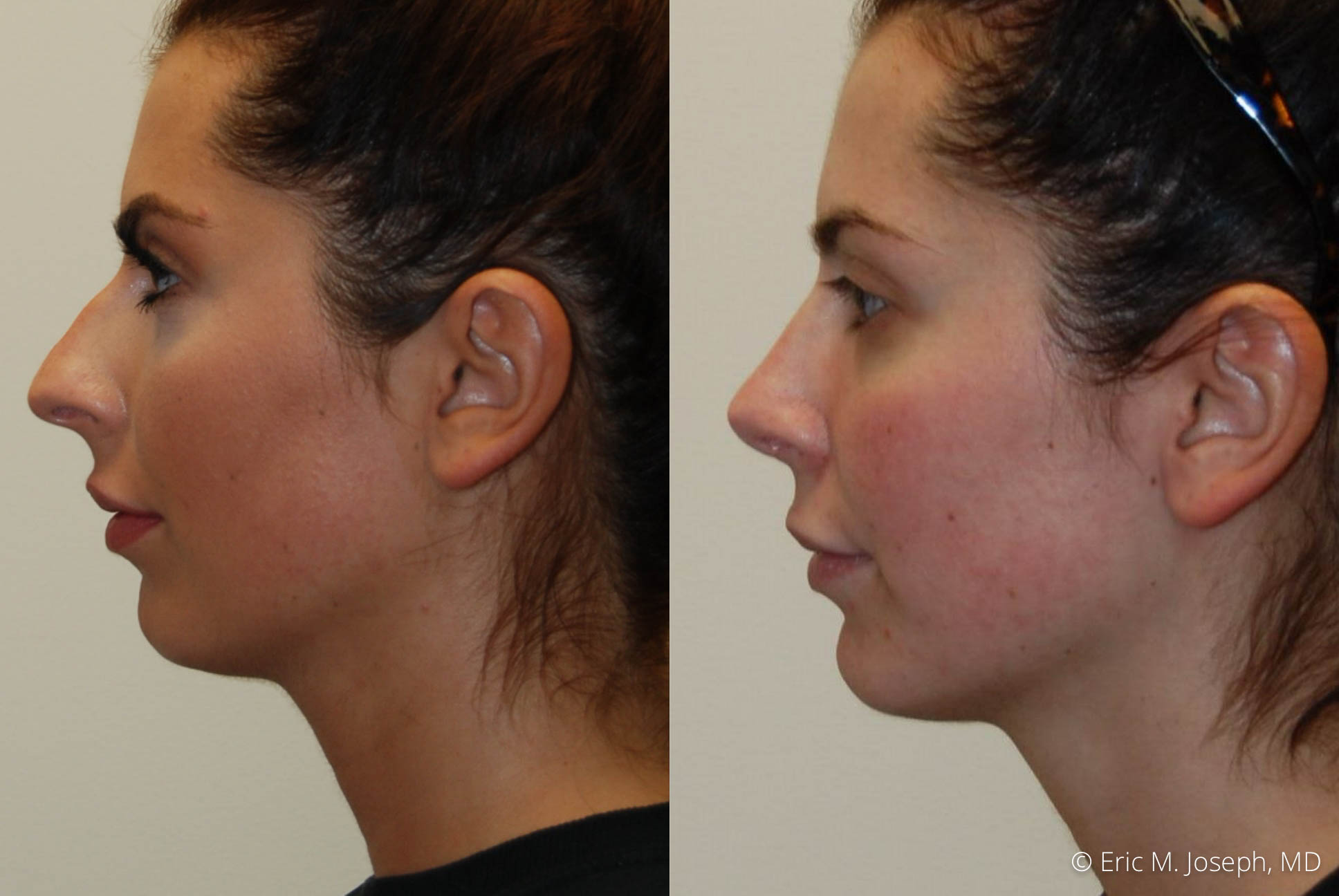 rhinoplasty-nj-nyc-nose-job-0374.jpg