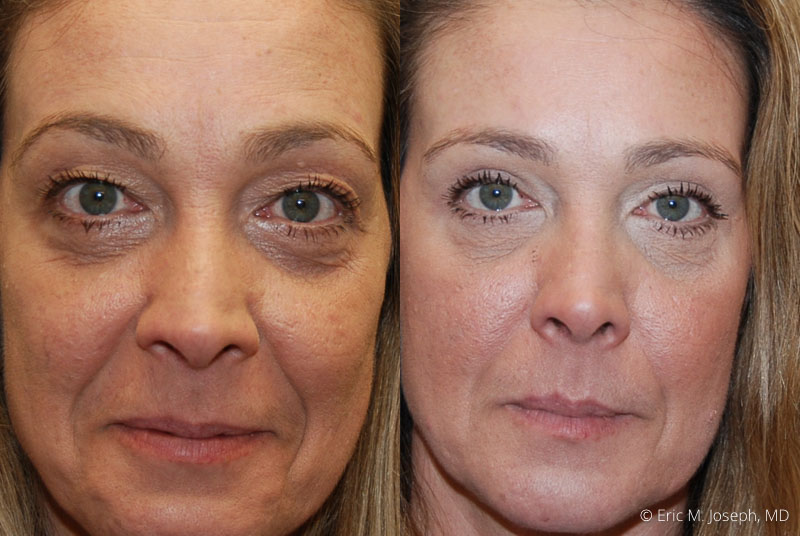 Blepharoplasty-0009.jpg