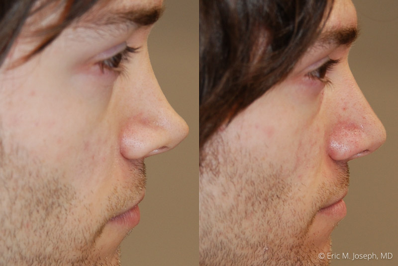 The Art of Nose Slimming with Muscle Relaxants: A Non-Surgical Marvel -  Advanced Cosmetic Medicine