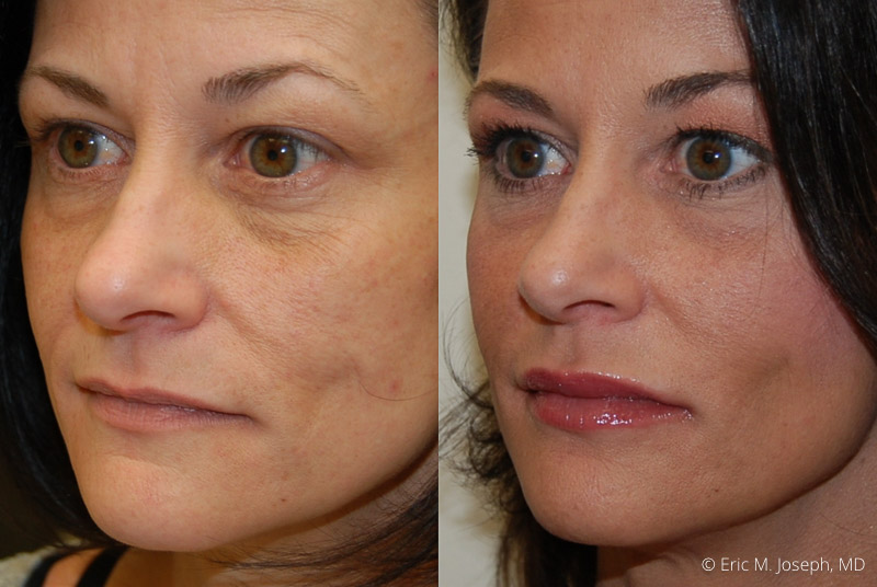 FacialRejuvenation-0003.jpg