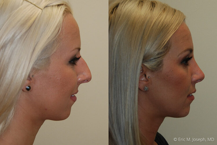 Rhinoplasty-0008.jpg