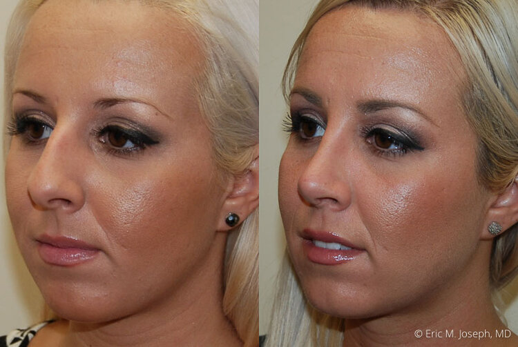 Rhinoplasty-0010.jpg