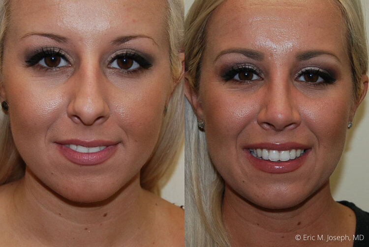 Rhinoplasty-0011.jpg