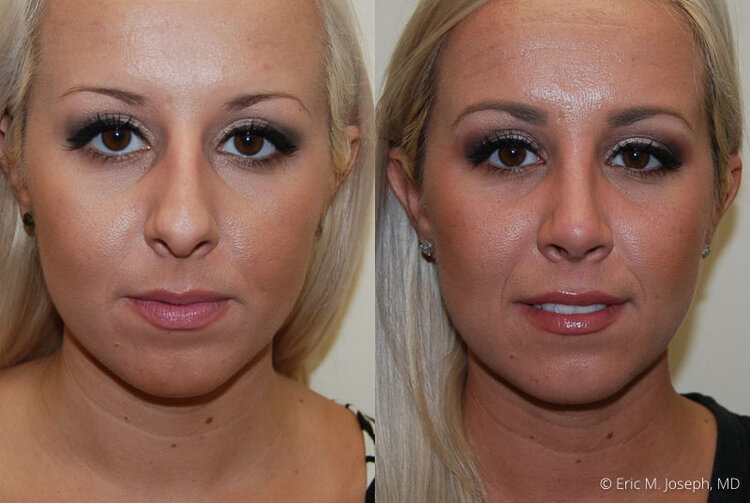 Rhinoplasty-0012.jpg