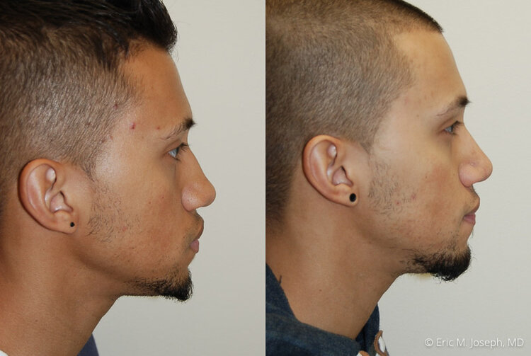 Rhinoplasty-0013.jpg