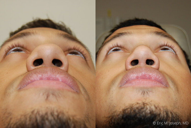 Rhinoplasty-0014.jpg