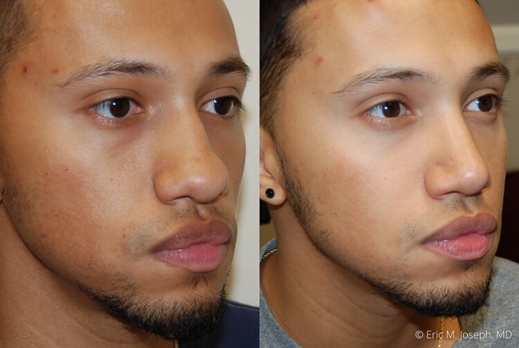 Rhinoplasty-0016.jpg