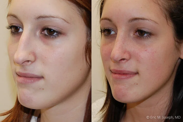 Rhinoplasty-0028.jpg
