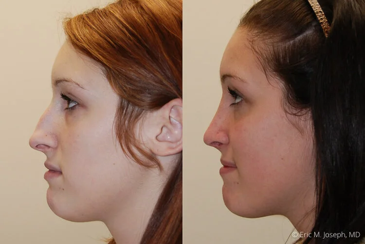 Rhinoplasty-0029.jpg