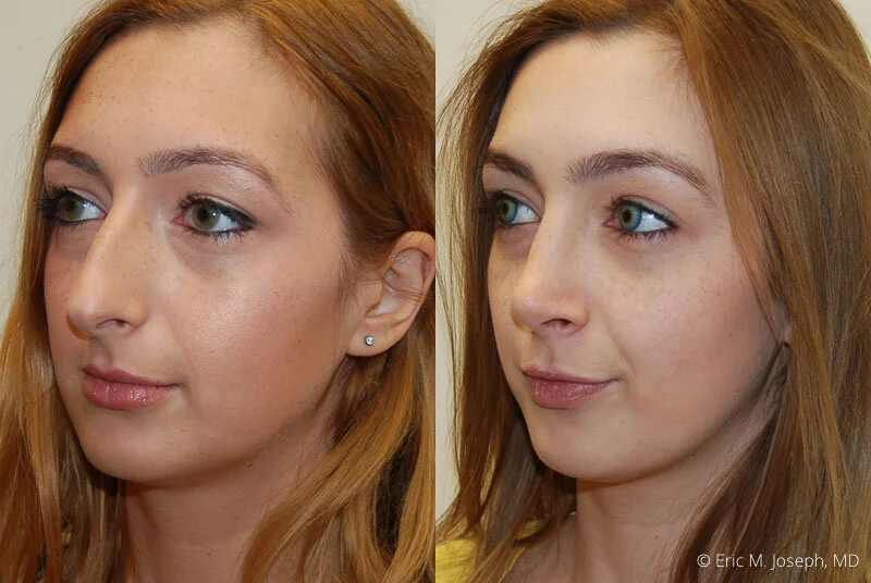 Rhinoplasty-0030.jpg