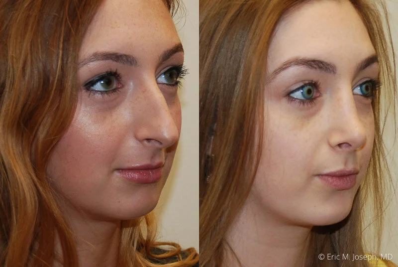 Rhinoplasty-0031.jpg