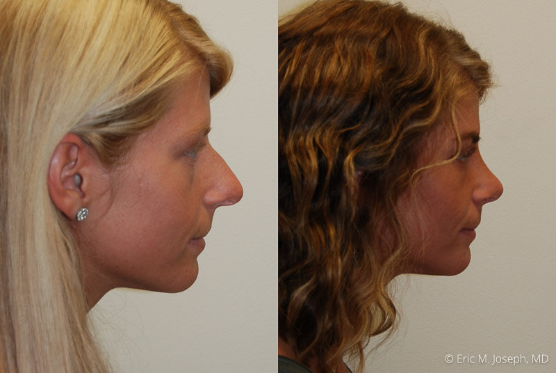 Rhinoplasty-0033.jpg