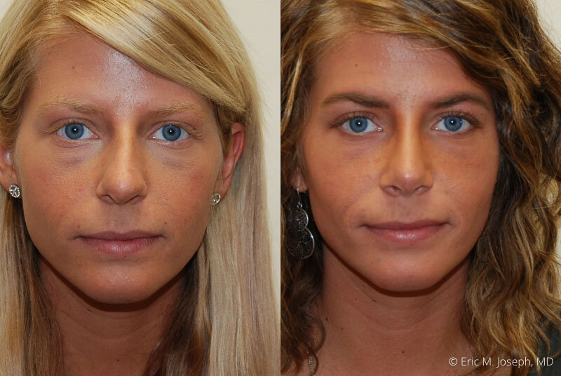 Rhinoplasty-0036.jpg