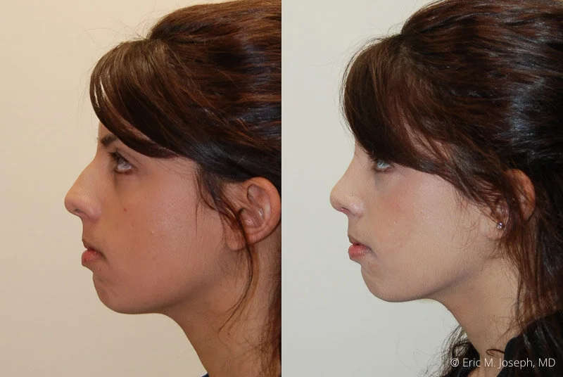 Rhinoplasty-0037.jpg