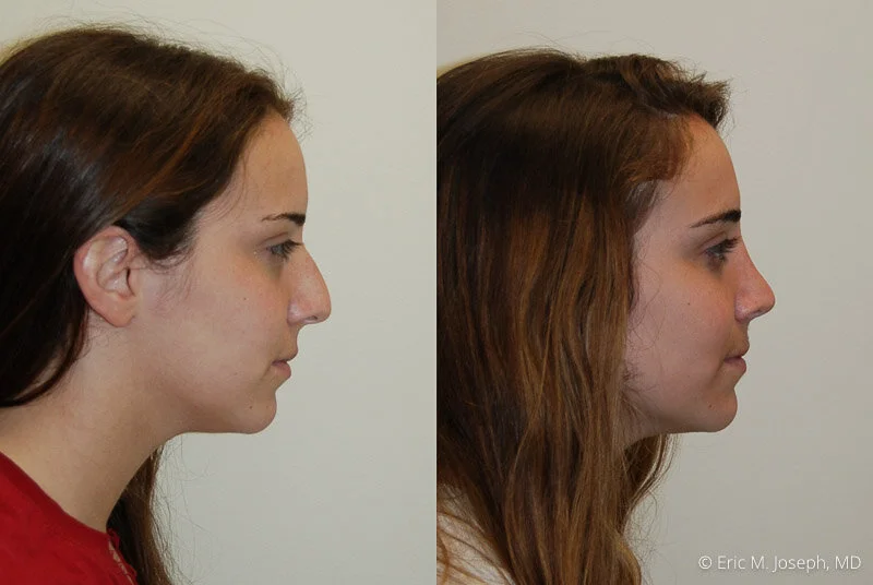 Rhinoplasty-0041.jpg