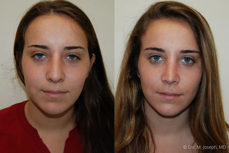 Rhinoplasty-0043.jpg