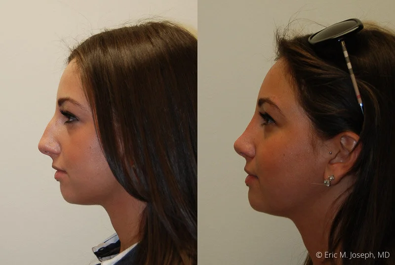 Rhinoplasty-0045.jpg