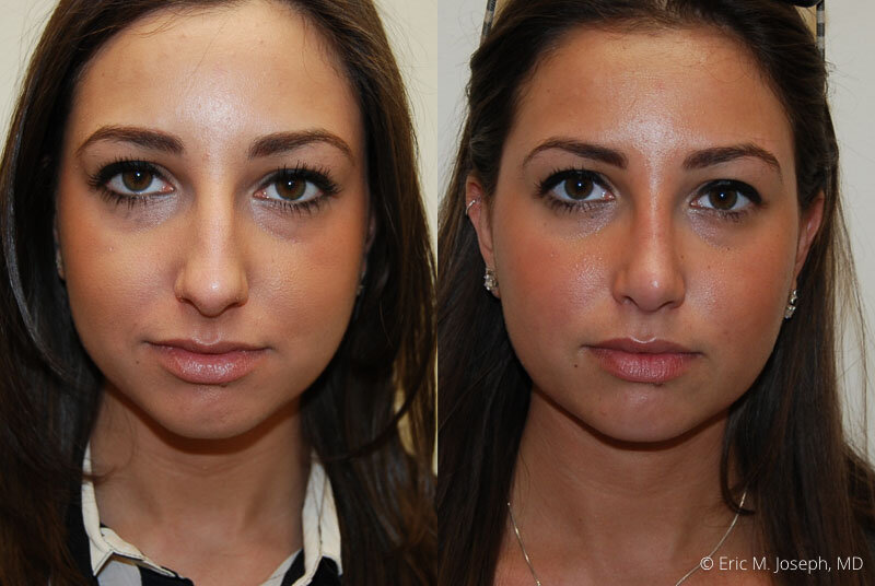 Rhinoplasty-0044.jpg