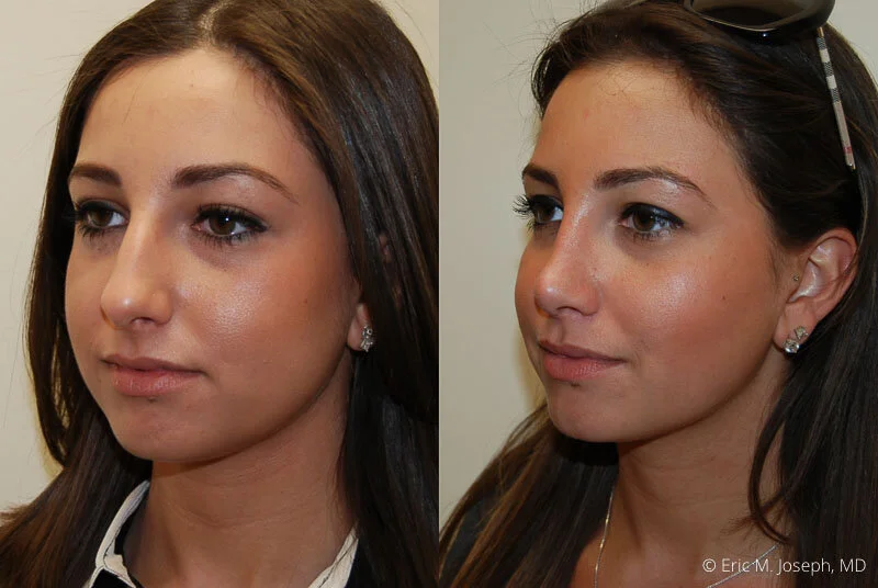 Rhinoplasty-0046.jpg