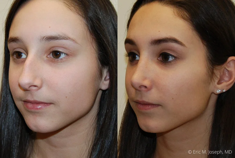 Rhinoplasty-0048.jpg