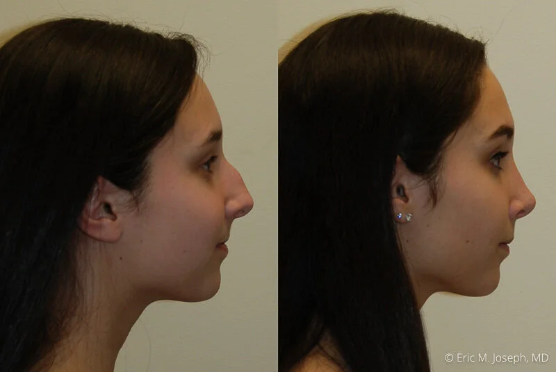 Rhinoplasty-0051.jpg
