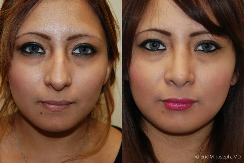 Rhinoplasty-0053.jpg