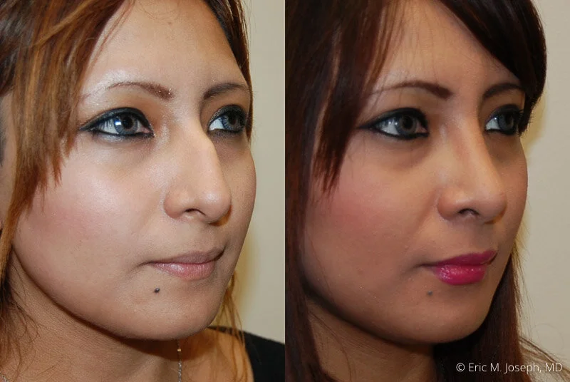 Rhinoplasty-0052.jpg