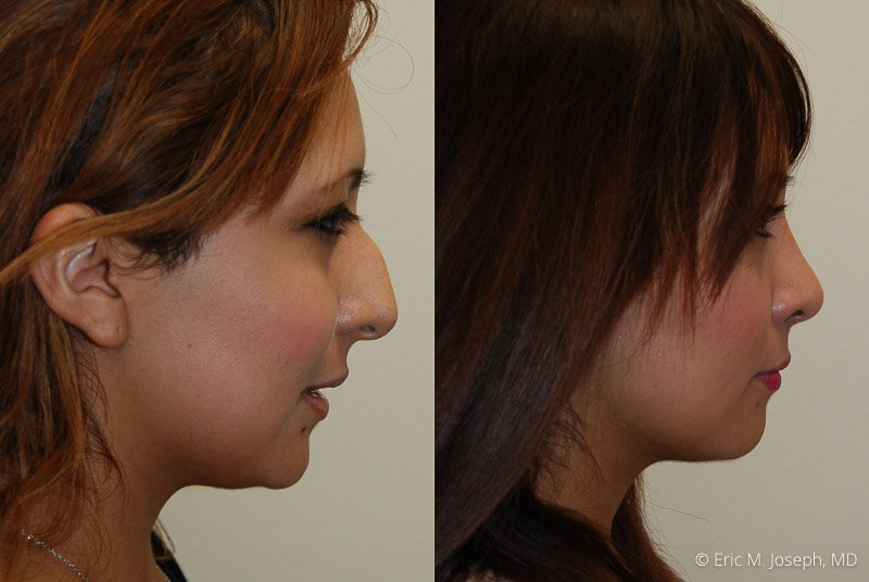 Rhinoplasty-0054.jpg