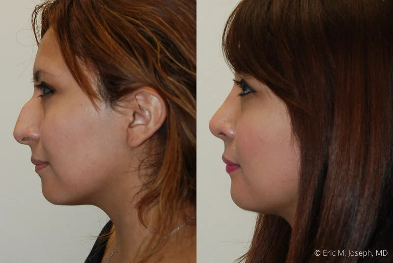 Rhinoplasty-0055.jpg