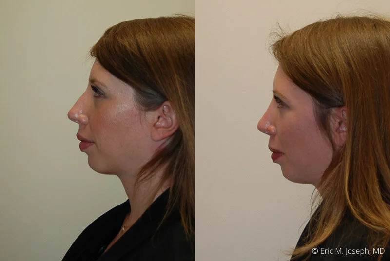Rhinoplasty-0057.jpg