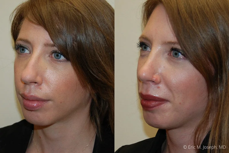 Rhinoplasty-0058.jpg