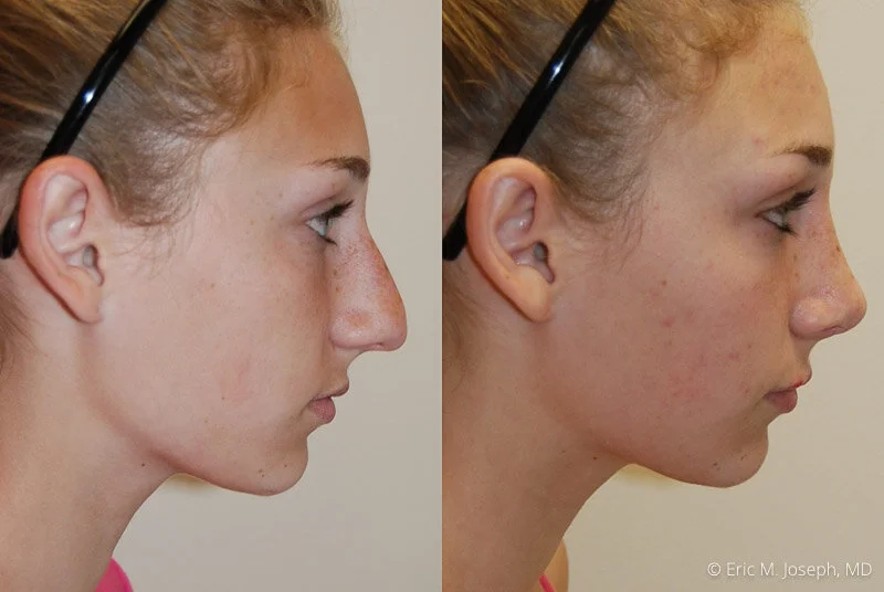 Rhinoplasty-0063.jpg