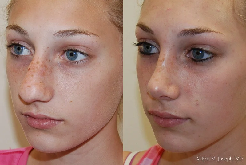 Rhinoplasty-0064.jpg