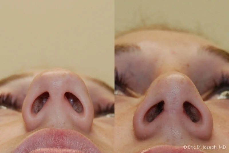 Rhinoplasty-0066.jpg