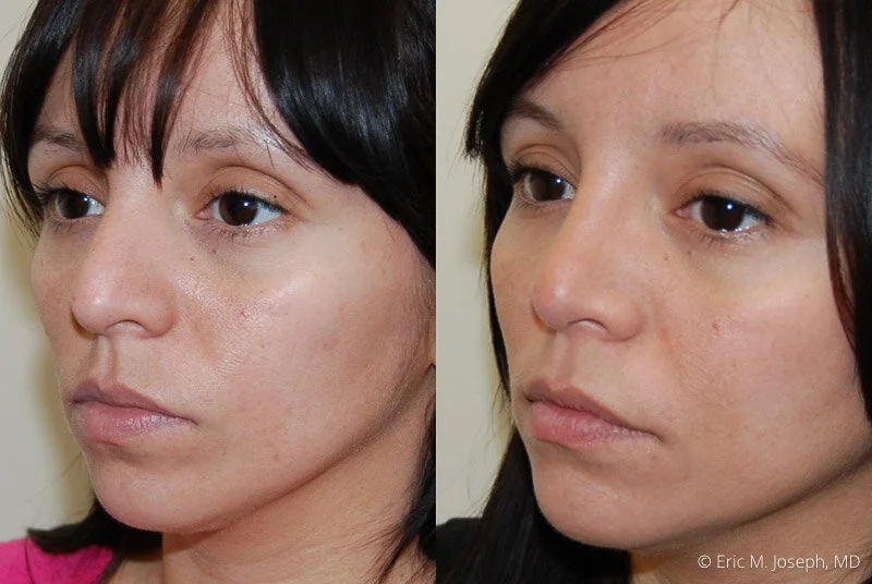 Rhinoplasty-0068.jpg