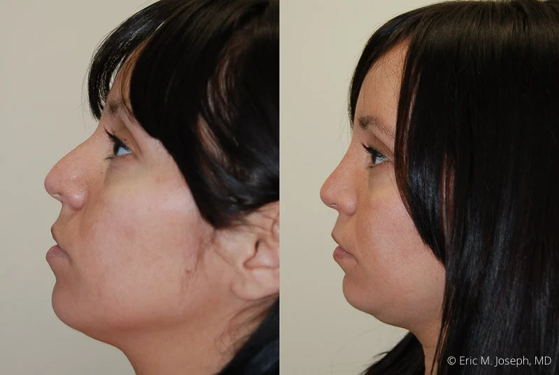 Rhinoplasty-0069.jpg
