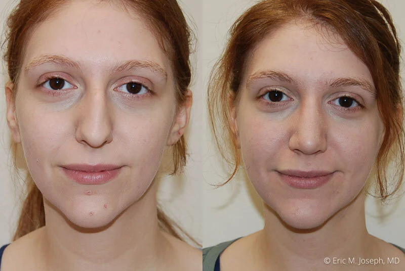 Rhinoplasty-0071.jpg