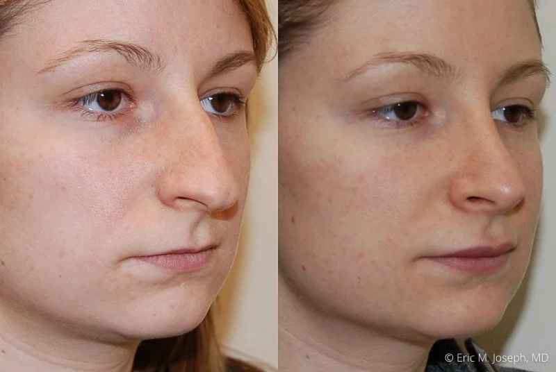 Rhinoplasty-0080.jpg