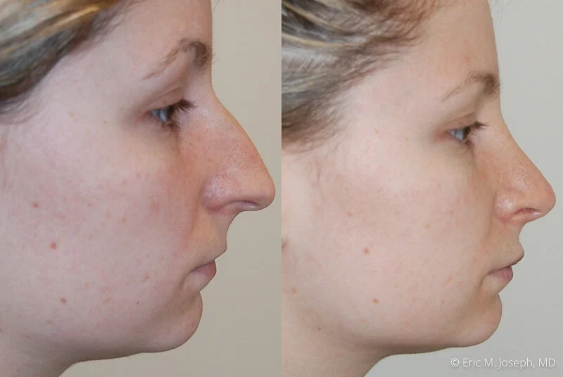 Rhinoplasty-0081.jpg