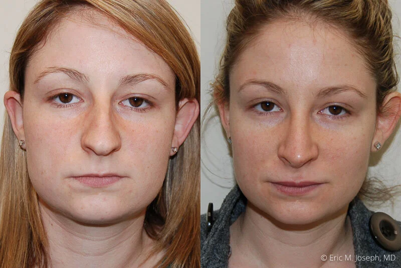 Rhinoplasty-0082.jpg