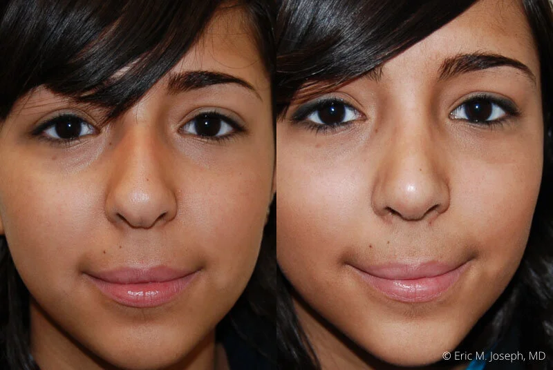 Rhinoplasty-0083.jpg
