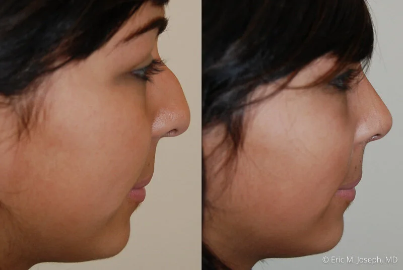 Rhinoplasty-0085.jpg