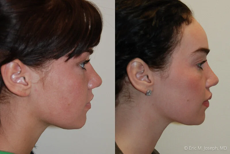 Rhinoplasty-0086.jpg