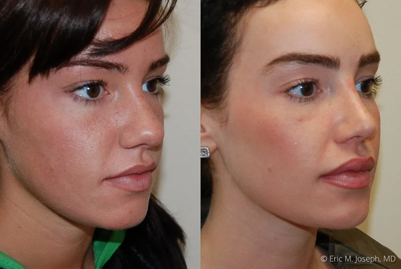 Rhinoplasty-0087.jpg
