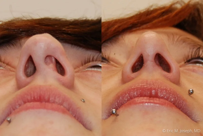 Rhinoplasty-0095.jpg